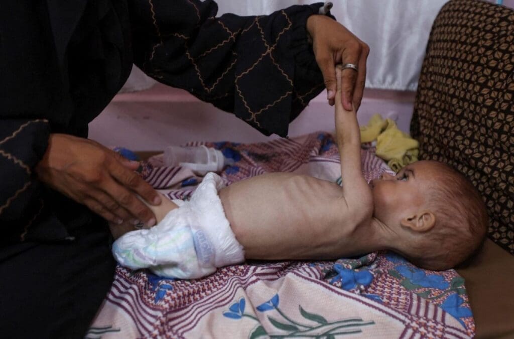 Malnourished Palestinian girl receives treatment.